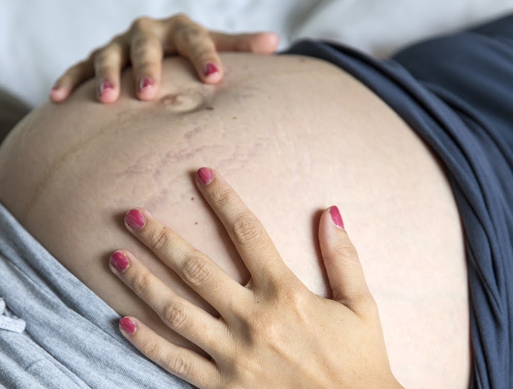 mama met zwangere buik met striemen