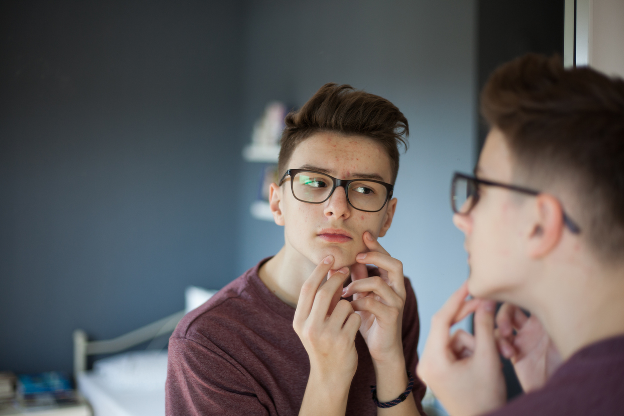 tienerjongen met acne kijkt in de spiegel