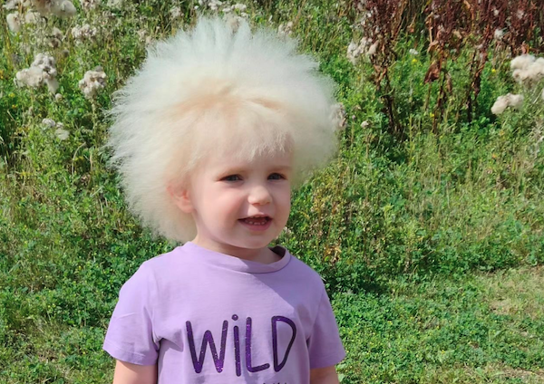 uncombable hair syndrome layla