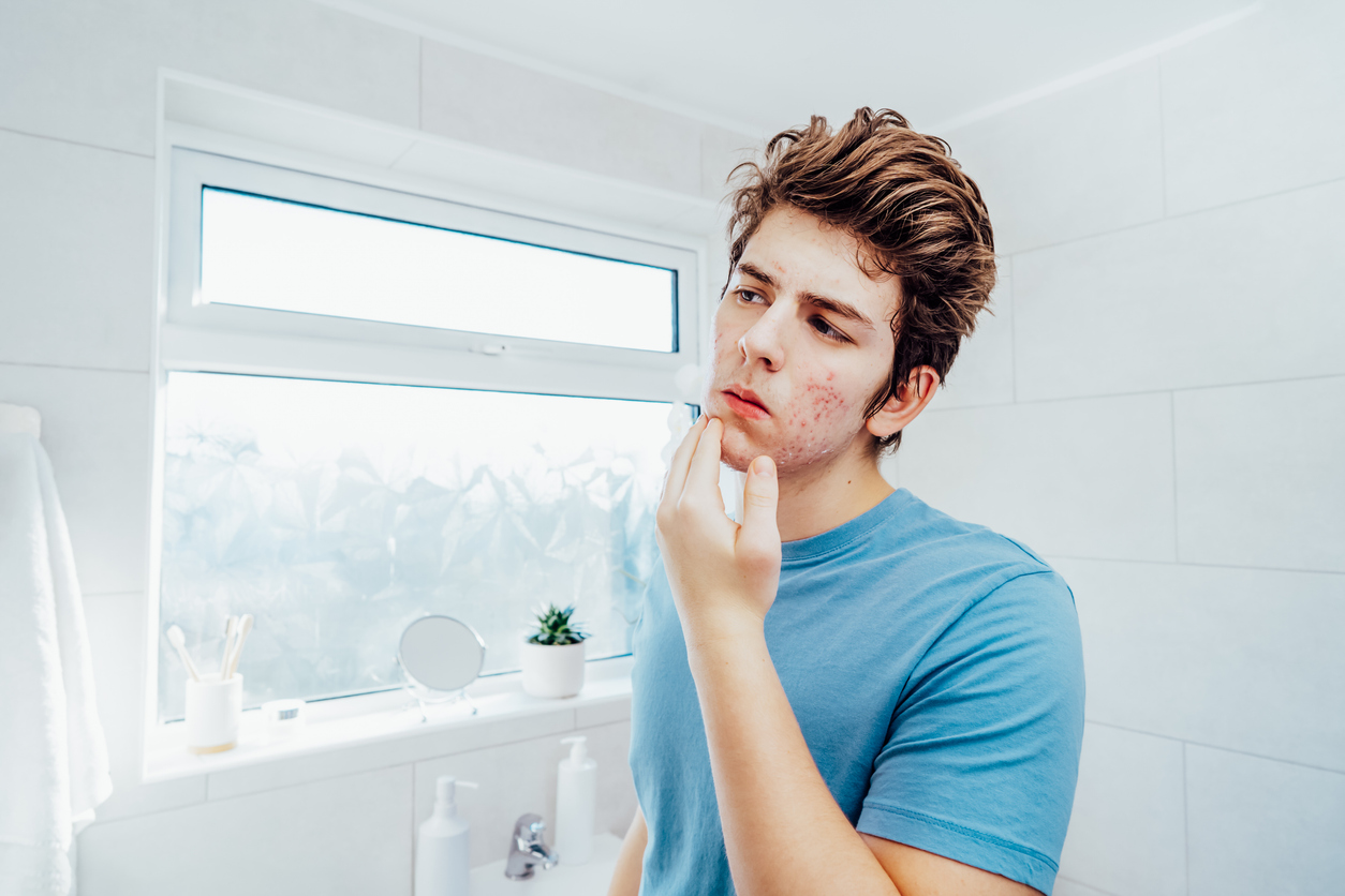 tienerjongen met acne