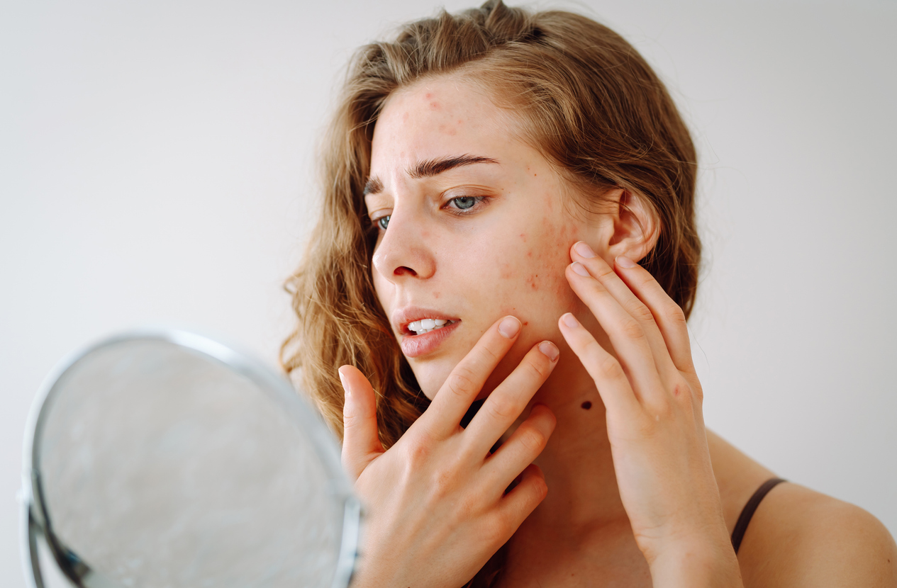 vrouw met acne kijkt in spiegel