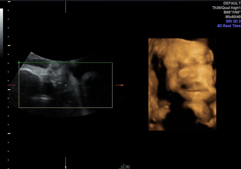 echografie van het tweede kindje van Wenke